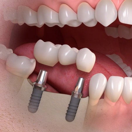 Когда необходимо протезирование зубов?